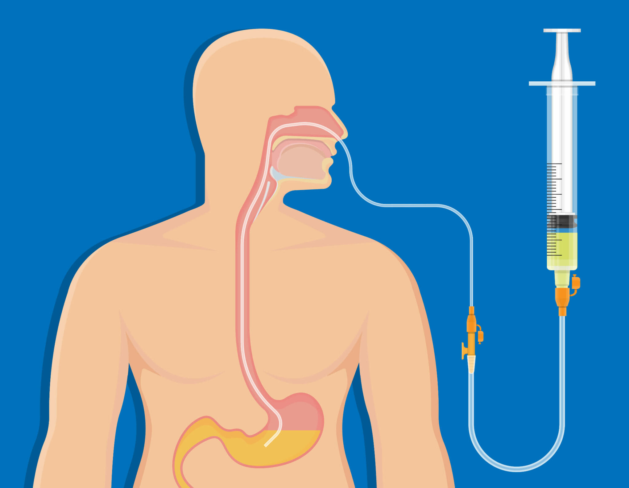 ingenza-s-revolutionary-ph-strips-improve-nasogastric-feeding-tube